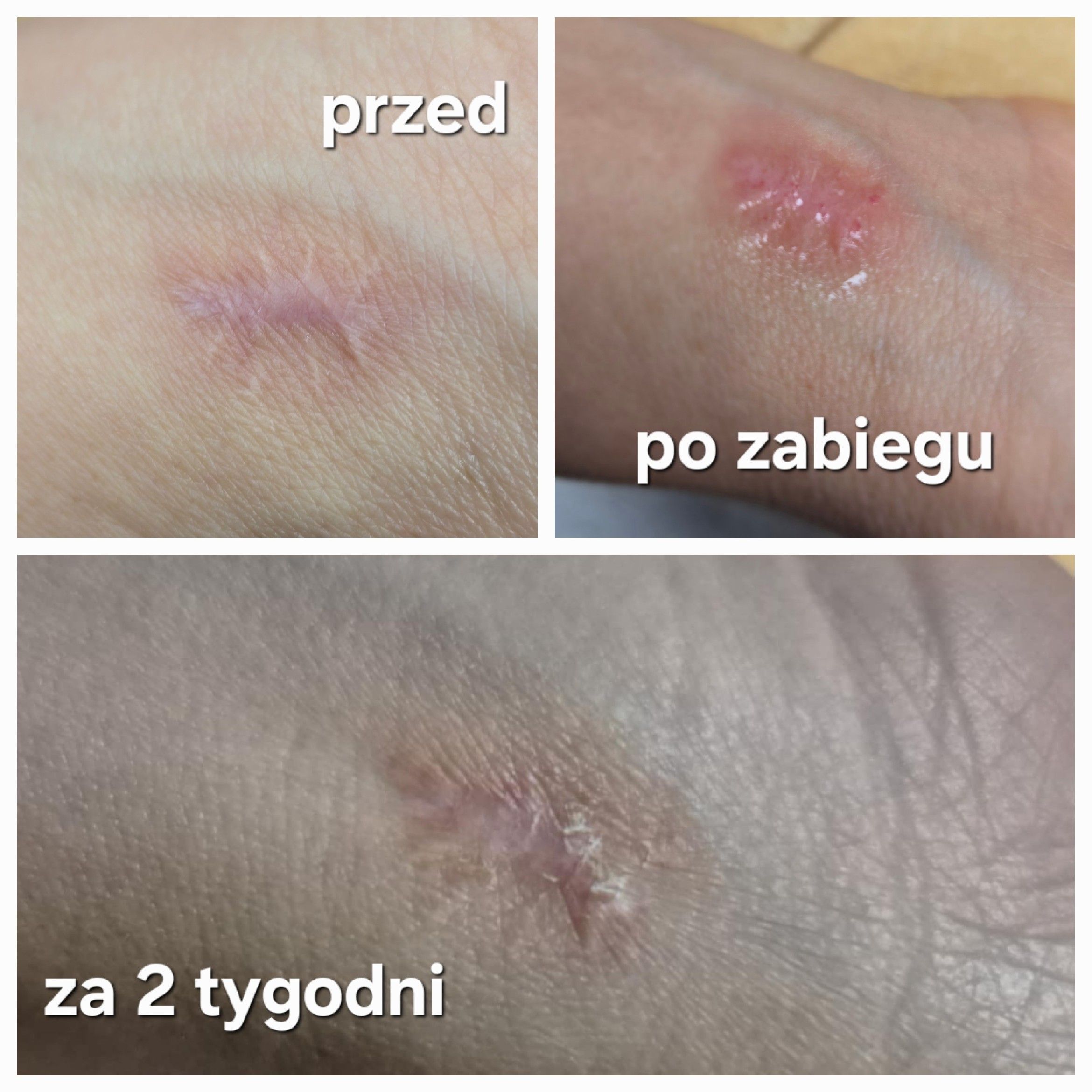 Mikroneedling blizn - efekt – galeria zdjęć zabiegu kosmetycznego